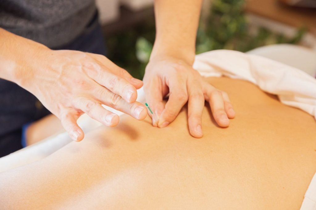 Image of Therapist treating patient with needles during procedure of alternative medicine